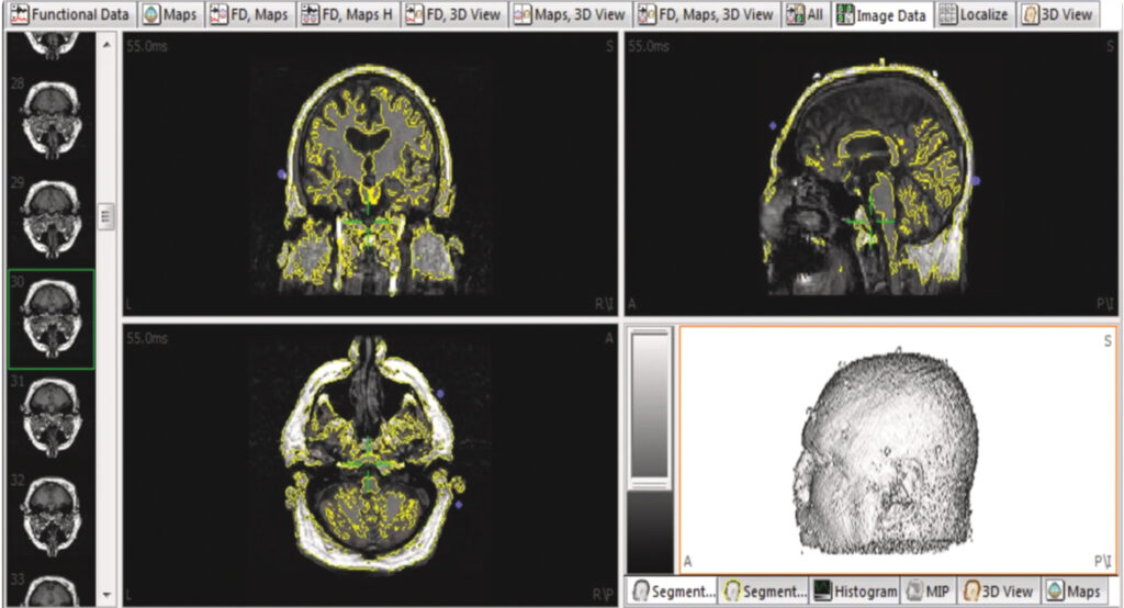 An image divided into four main quadrants shows three different views of a human brain via computer scan, with certain parts lit up in yellow. A fourth quadrant shows a grainy gray image of a person's head in the helmet that is used to scan the brain. Along the borders of the image are smaller images of the brain.