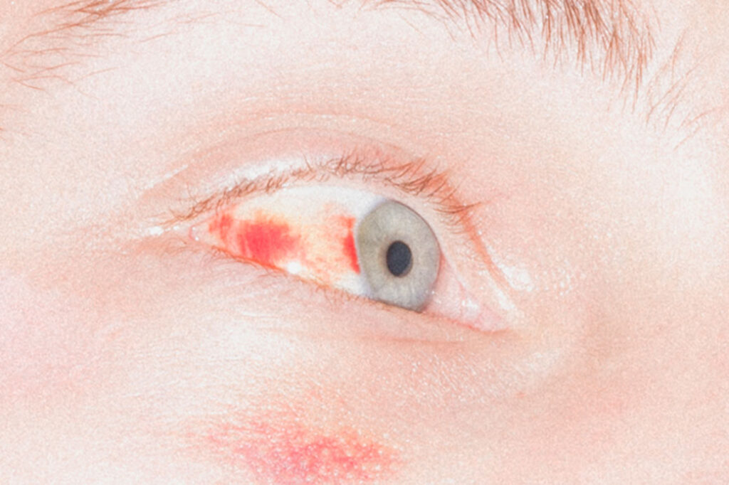 closeup of human eye that is partially bloodshot with a blue grey iris