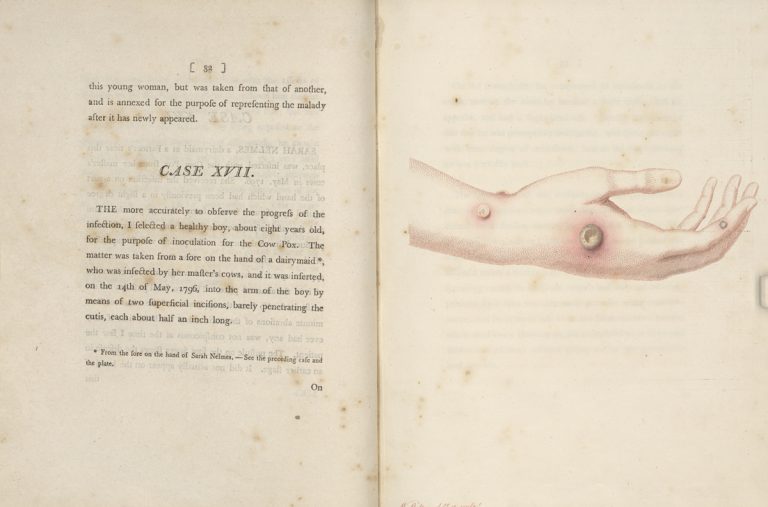 Page 32 from “An Inquiry into the Causes and Effects of the Variolae Vaccine” by Edward Jenner, 1798. In Jenner’s 17th case study, he inoculates for the first time a healthy patient who has no previous exposure to cowpox or smallpox. “I selected a healthy boy, about eight years old, for the purpose of inoculation for the Cow Pox. The matter was taken from the sore on the hand of a dairymaid, who was infected by her master’s cows…”