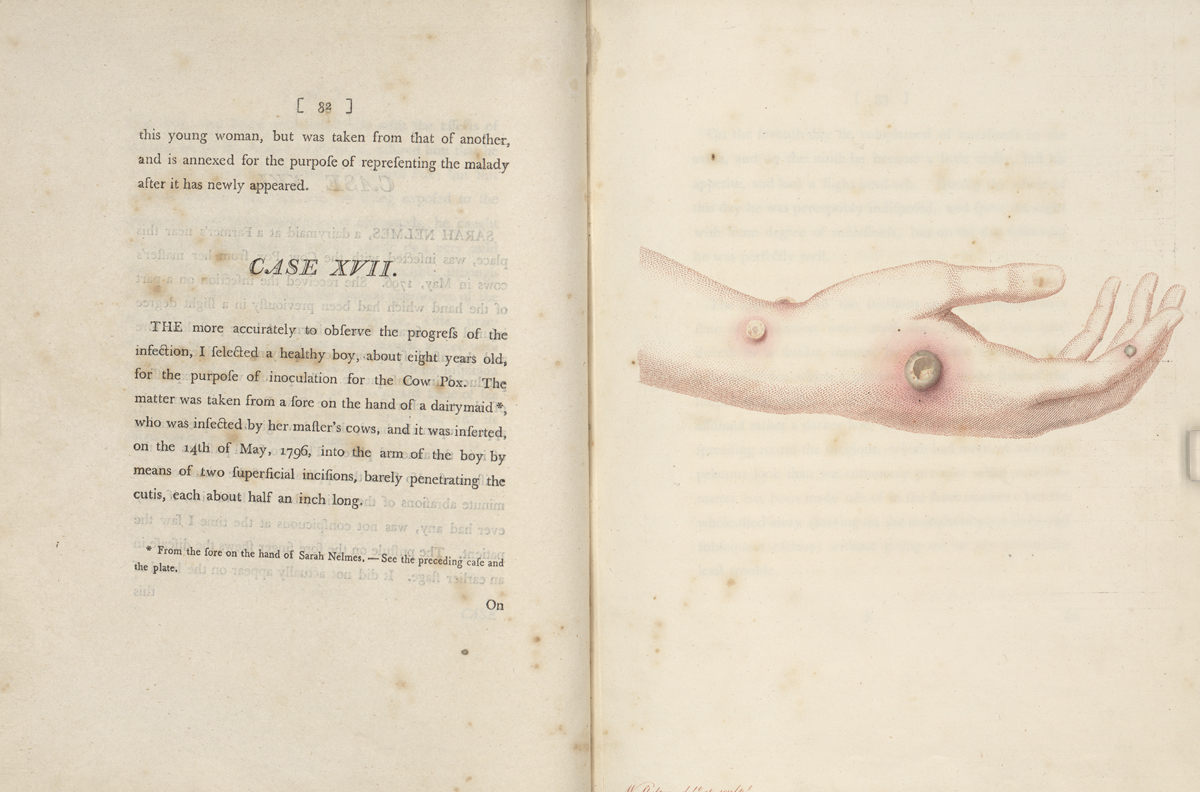 Page 32 from “An Inquiry into the Causes and Effects of the Variolae Vaccine” by Edward Jenner, 1798. In Jenner’s 17th case study, he inoculates for the first time a healthy patient who has no previous exposure to cowpox or smallpox. “I selected a healthy boy, about eight years old, for the purpose of inoculation for the Cow Pox. The matter was taken from the sore on the hand of a dairymaid, who was infected by her master’s cows…”