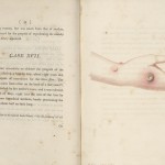Page 32 from “An Inquiry into the Causes and Effects of the Variolae Vaccine” by Edward Jenner, 1798. In Jenner’s 17th case study, he inoculates for the first time a healthy patient who has no previous exposure to cowpox or smallpox. “I selected a healthy boy, about eight years old, for the purpose of inoculation for the Cow Pox. The matter was taken from the sore on the hand of a dairymaid, who was infected by her master’s cows…”