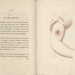 Page 36 from “An Inquiry into the Causes and Effects of the Variolae Vaccine” by Edward Jenner, 1798. Jenner’s book was supplemented by detailed, color engraving prints by artist William Skelton. These illustrations, corresponding to adjacent case studies in the book, show the characteristic sores and pustules of cowpox patients.