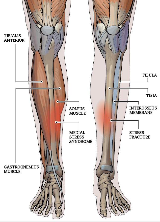 Initial radiographs show suspected tibial stress fracture or shin   Download Scientific Diagram