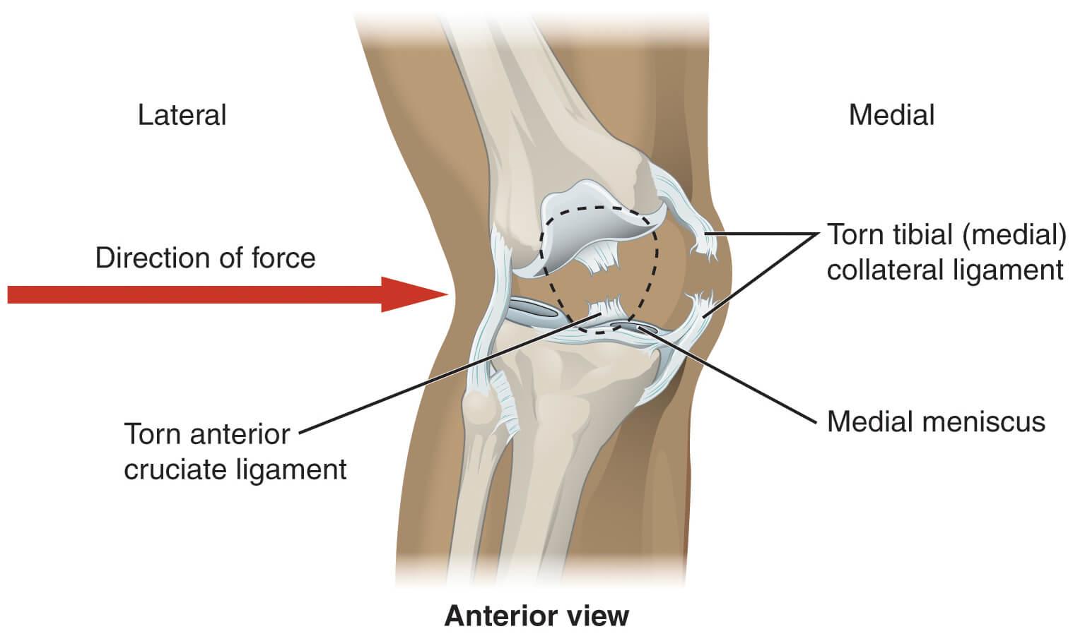 Anterior Cruciate Ligament (ACL) & Medial Collateral Knee Ligament